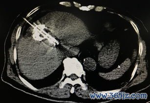 微波消融：微波加热烧死肿瘤