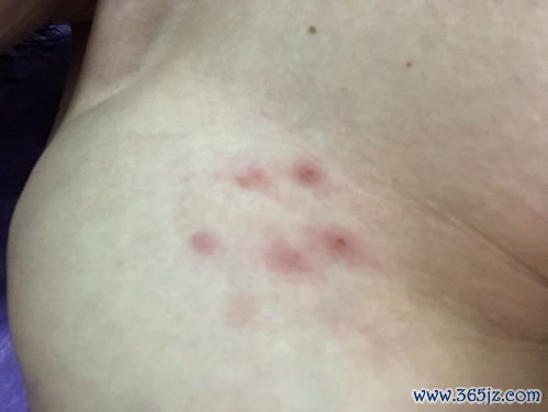 大两侧长了小疙瘩不痛不痒是什么东西需要处理吗