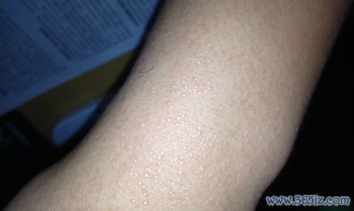 大两侧长了小疙瘩不痛不痒是什么东西需要处理吗