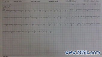 心律失常：心跳忽快忽慢：哪种需要治？哪种可以观察？