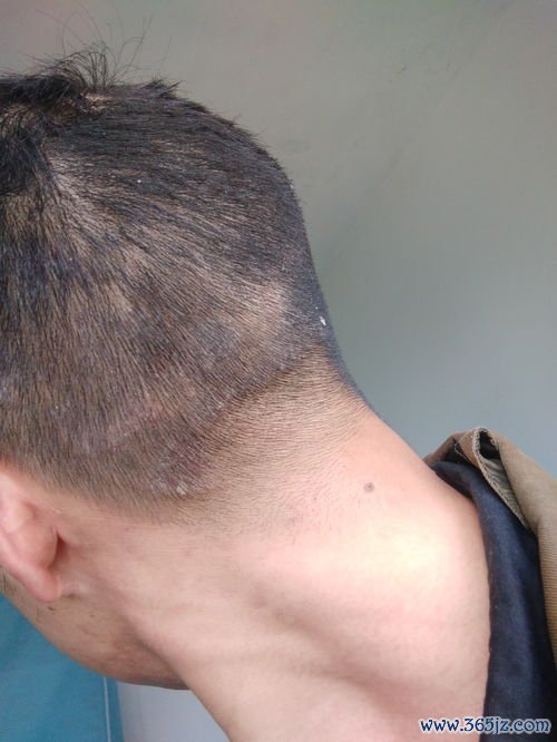 头红肿怎么办用什么药