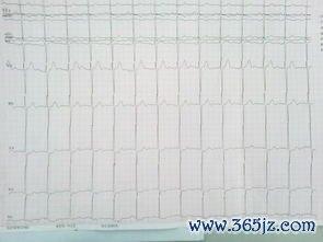 心电图：心电图正常≠心脏没病，这话医生常讲