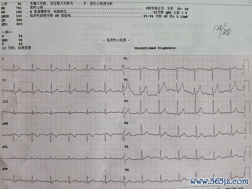 心电图：心电图正常≠心脏没病，这话医生常讲
