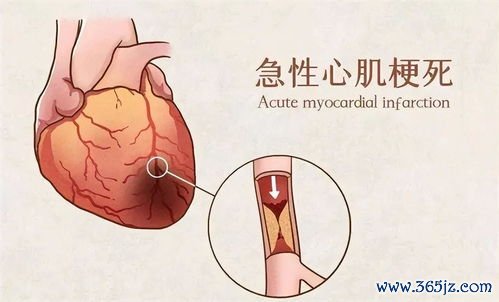 心肌梗死：心梗最怕的不是疼，是不疼——无症状心梗更凶险