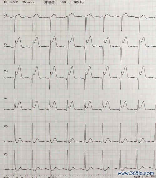 心肌梗死：心梗最怕的不是疼，是不疼——无症状心梗更凶险