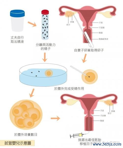 做试管婴儿的过程