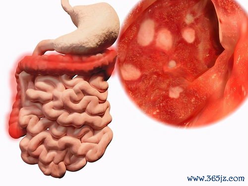 溃疡性结肠炎反复发作,看看是不是吃了这些 溃疡性结肠炎反复发作,看看是不是吃了这些
