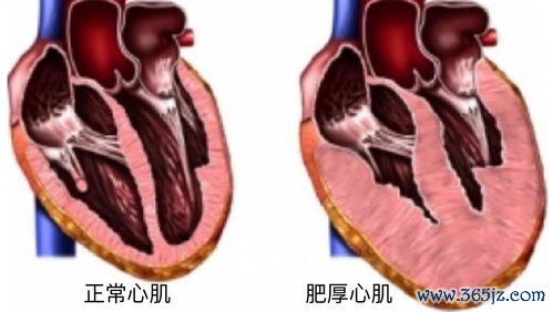 心肌病：扩心病心脏变大？还能缩回去吗？