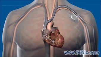 起搏器,心脏,装了,手机,微波炉