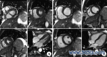 心脏,彩超,什么,EF,值多