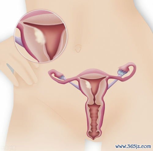 女性子宫保养怎么做能防肌瘤吗