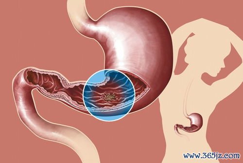 结核,腹痛,腹泻,肠镜,环形