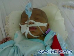 闭锁什么时候手术好