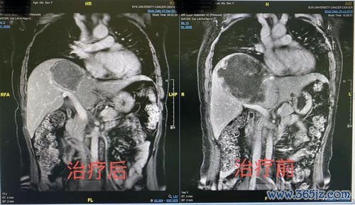 转移,肠癌,不能,手术,介入