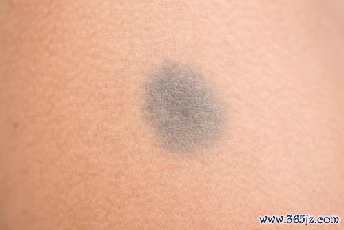 恶性,黑色素,变了,危险,皮肤癌