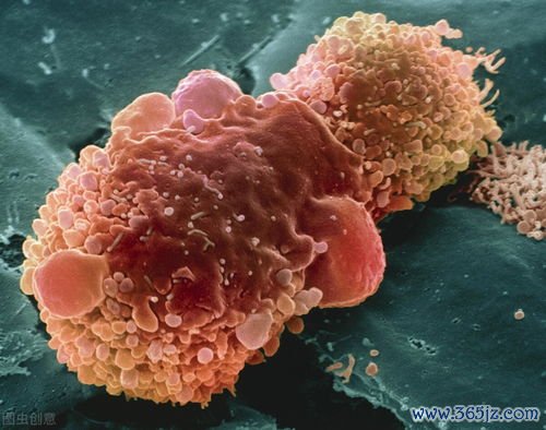 恶性,腹水,水里,癌细胞,抽水