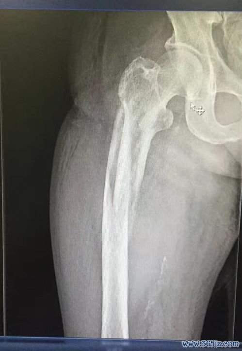 网片,骶骨,固定,术用,安全