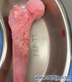 颗粒细胞瘤是恶性肿瘤吗