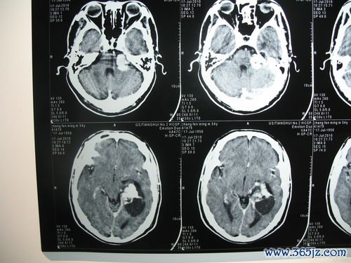 粒细胞,恶性肿瘤
