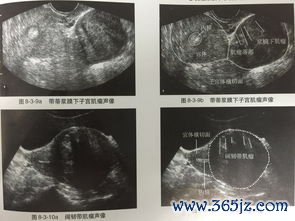 颗粒细胞瘤是恶性肿瘤吗需要切除子宫和卵巢吗