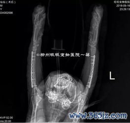 骶骨固定术用网片安全吗网片会侵蚀吗