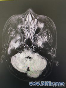 结节,性多,动脉炎,网状,多发