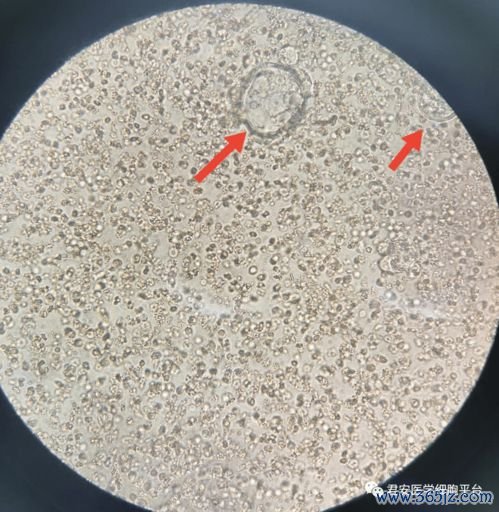 恶性,胸水,水里,癌细胞,抽水