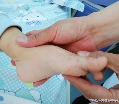 线状硬斑病-单侧肢体线状硬化，儿童