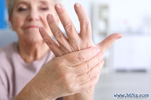 继发性干燥综合征-伴类风湿关节炎等