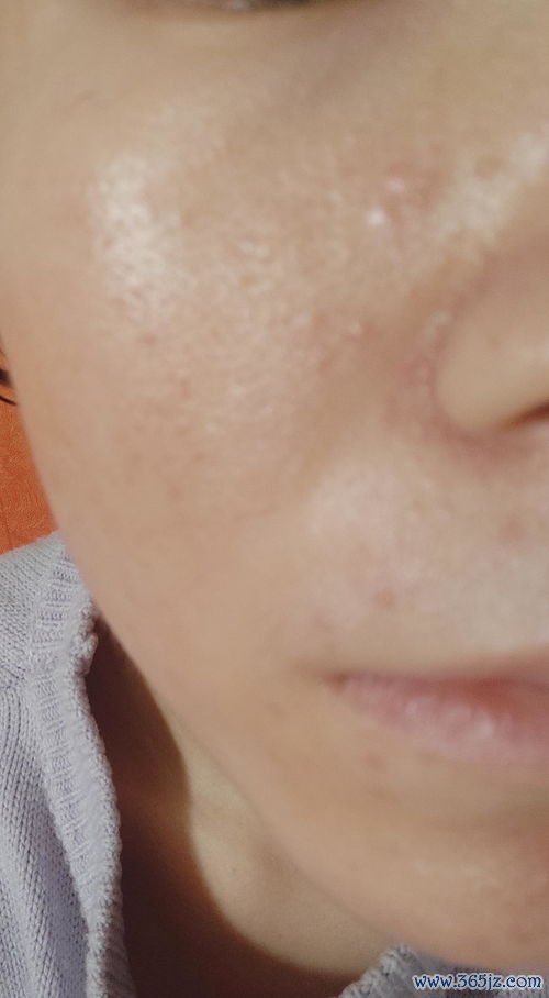 扁平疣：脸上手上扁平小疙瘩