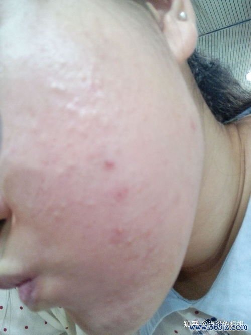 扁平疣：脸上手上扁平小疙瘩