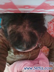 斑秃：一块块掉头发，鬼剃头