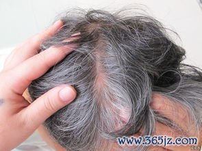 斑秃：一块块掉头发，鬼剃头