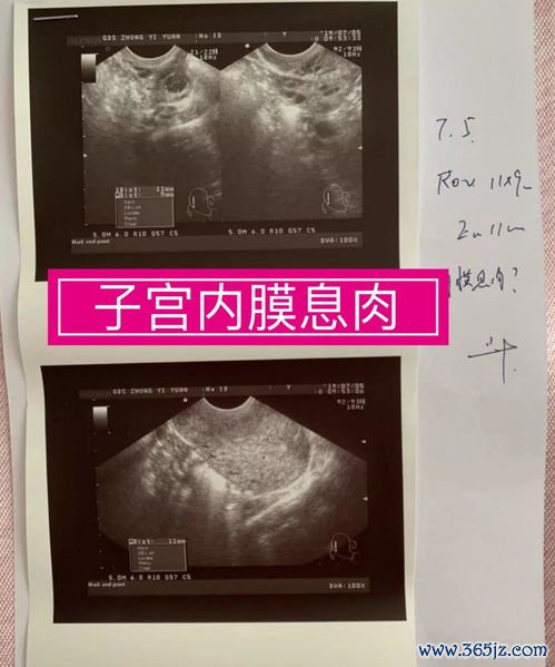 内膜薄可以做试管婴儿吗