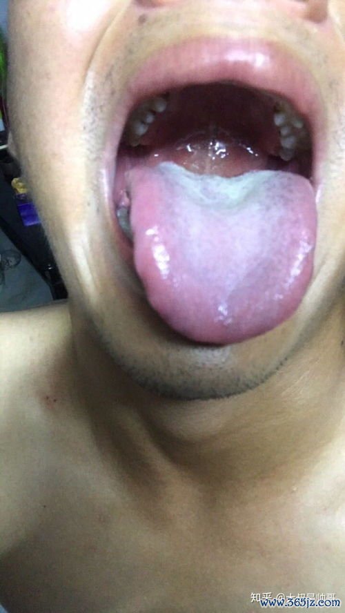 补阳还五补气行，气虚血瘀中风证