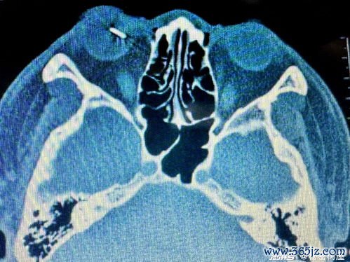 核磁共振：做核磁共振，身上有纹身行不行？