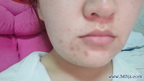 果酸换肤：刷酸治痘痘痘印