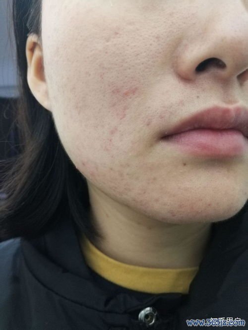 果酸换肤：刷酸治痘痘痘印