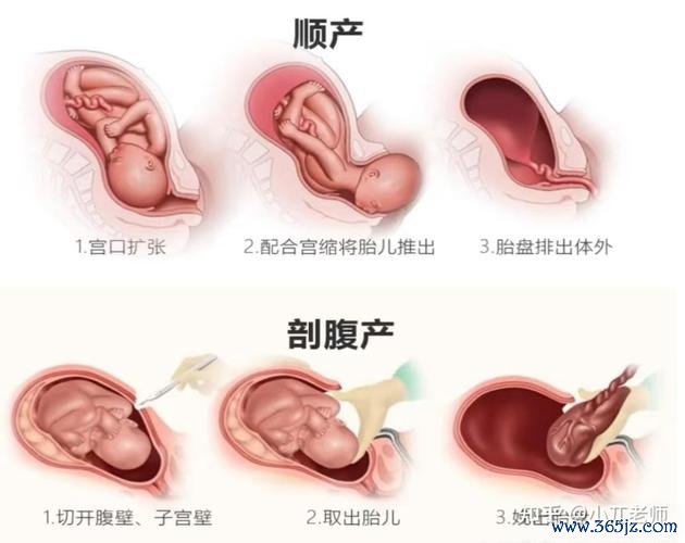 剖宫产还是顺产？试管妈妈可以自己生吗