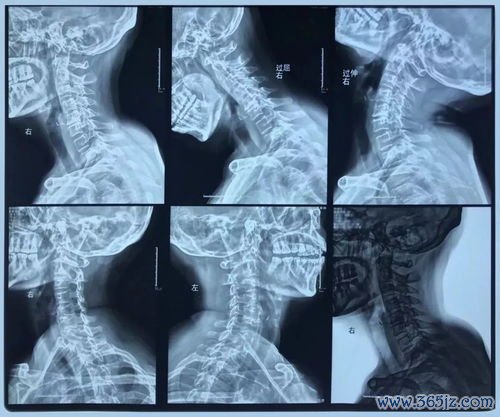 核磁共振：做核磁共振，身上有纹身行不行？金属牙套呢