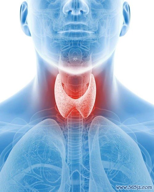桥本氏病：最常见的甲减病因——抗体攻击甲状腺