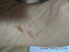 水痘：身上起泡，痒