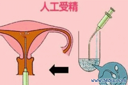 北京供精试管婴儿，供精条件流程费用全解