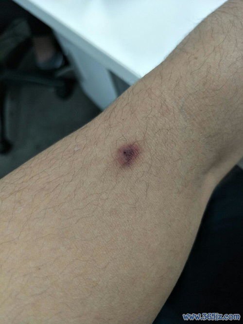 淋巴管瘤：软疙瘩