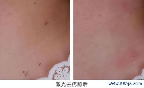 激光治疗：烧掉疣体