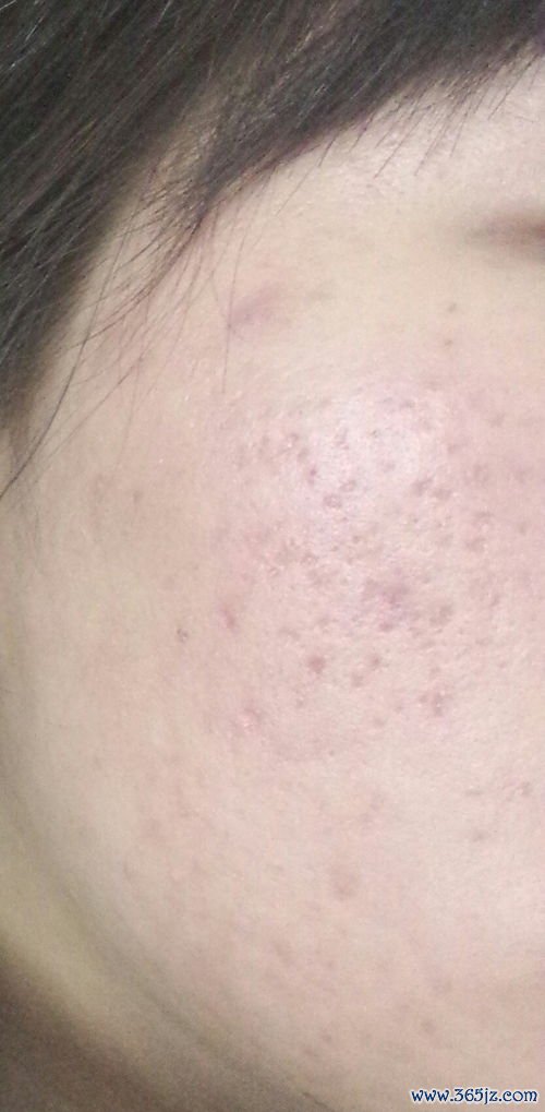 点阵激光：激光换肤治痘坑