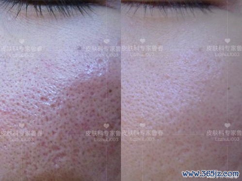 点阵激光：激光换肤治痘坑