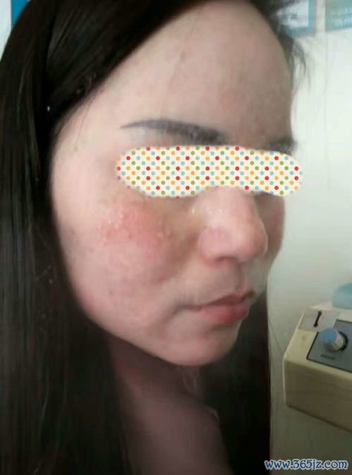 激素依赖性皮炎：用激素药膏用出依赖了