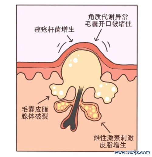 激素治疗：快速控制炎症，不能长期用