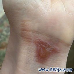 烫伤：烫了怎么办